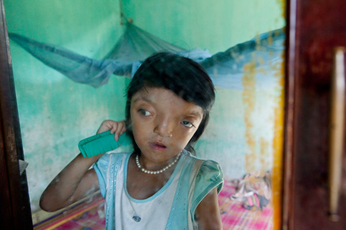 Danang, Vietnam, 36 ans après la guerre, l’agent orange tue encore…