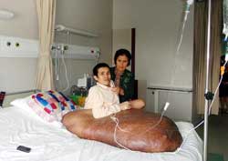 Vietnam : opéré d'une tumeur de 90 kilos Vietnam : opéré d'une tumeur de 90 kilos